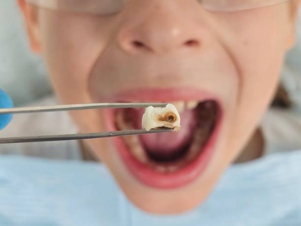 Best Knocked-Out Tooth (Avulsed Tooth) Treatment in Lucedale, MS